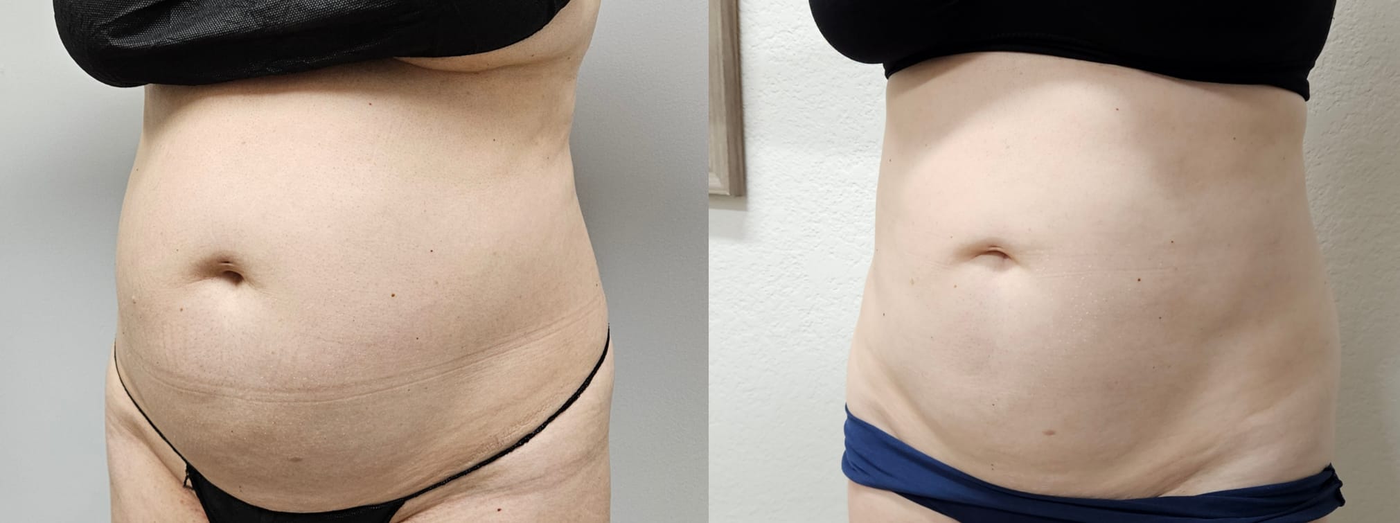 liposuction surgery before after results 2024