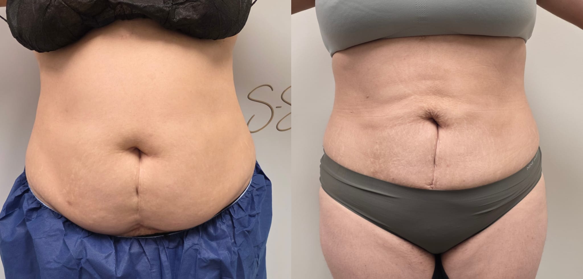 liposuction surgery before after results 2024