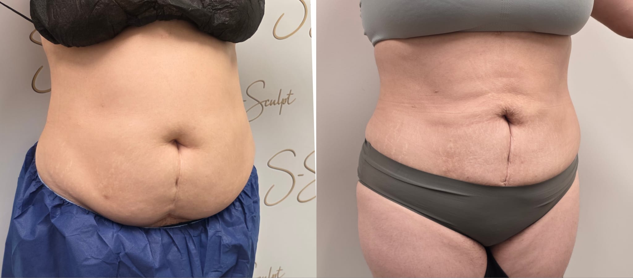 liposuction surgery before after results 2024