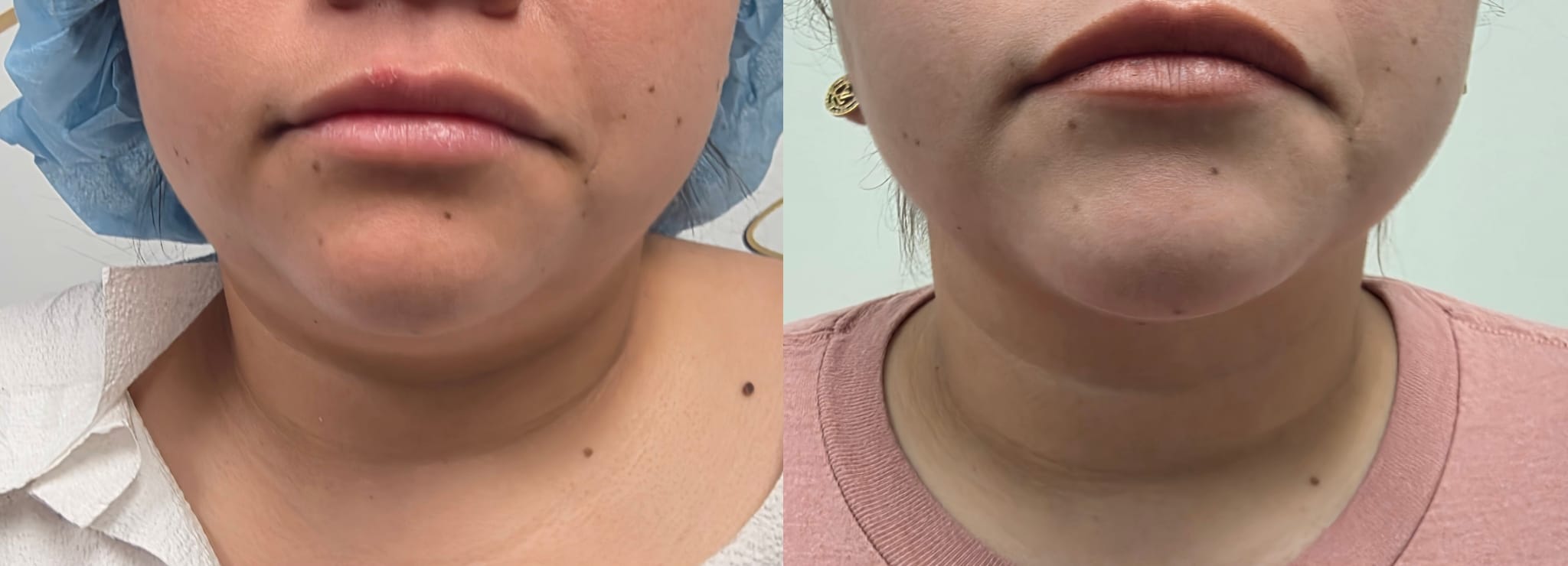 liposuction surgery before after results 2024