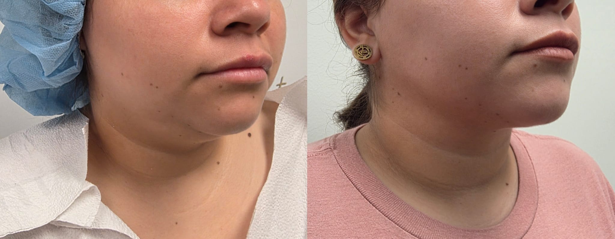 liposuction surgery before after results 2024