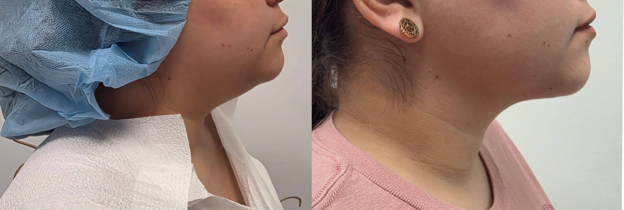 liposuction surgery before after results 2024