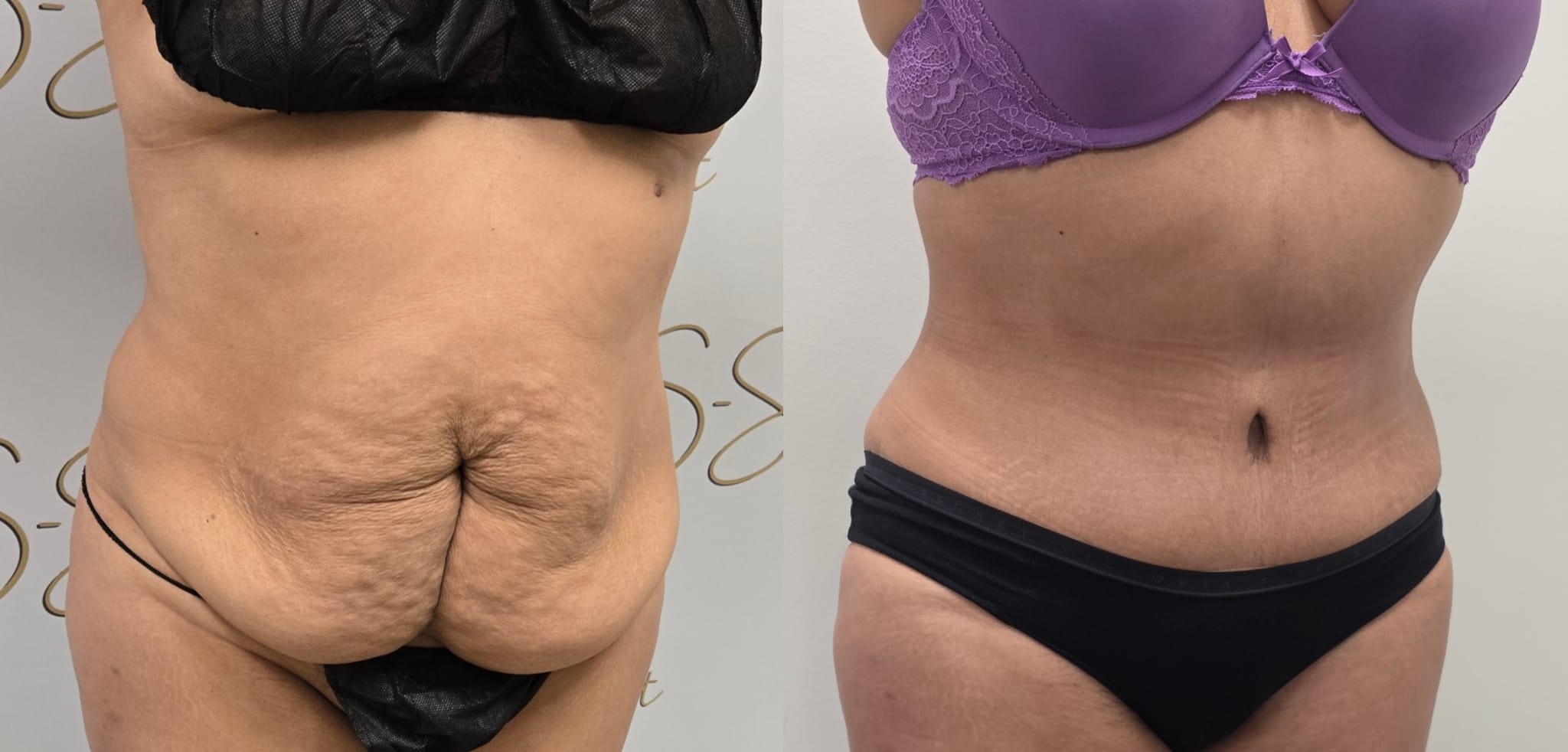 liposuction surgery before after results 2024