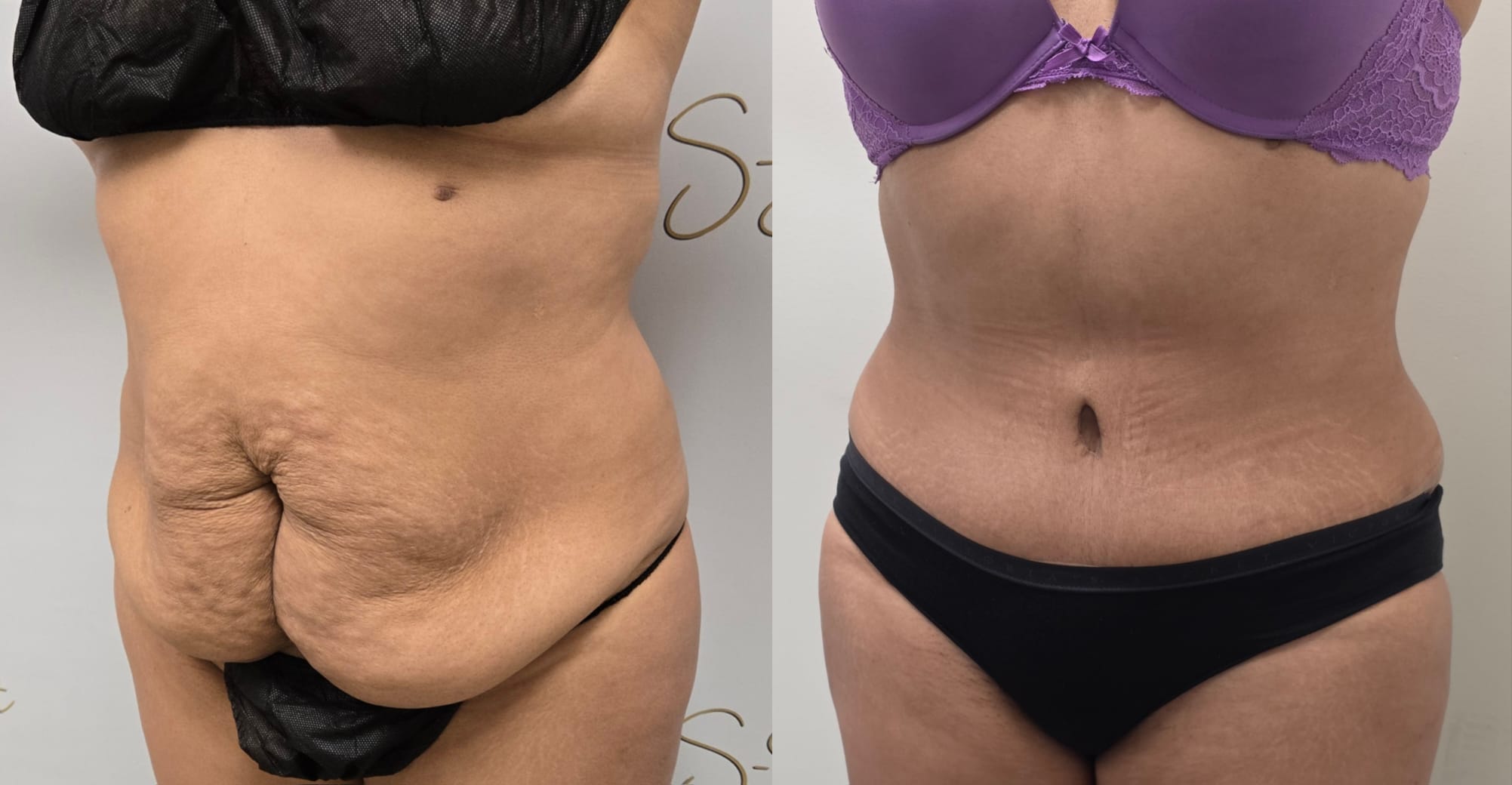 liposuction surgery before after results 2024