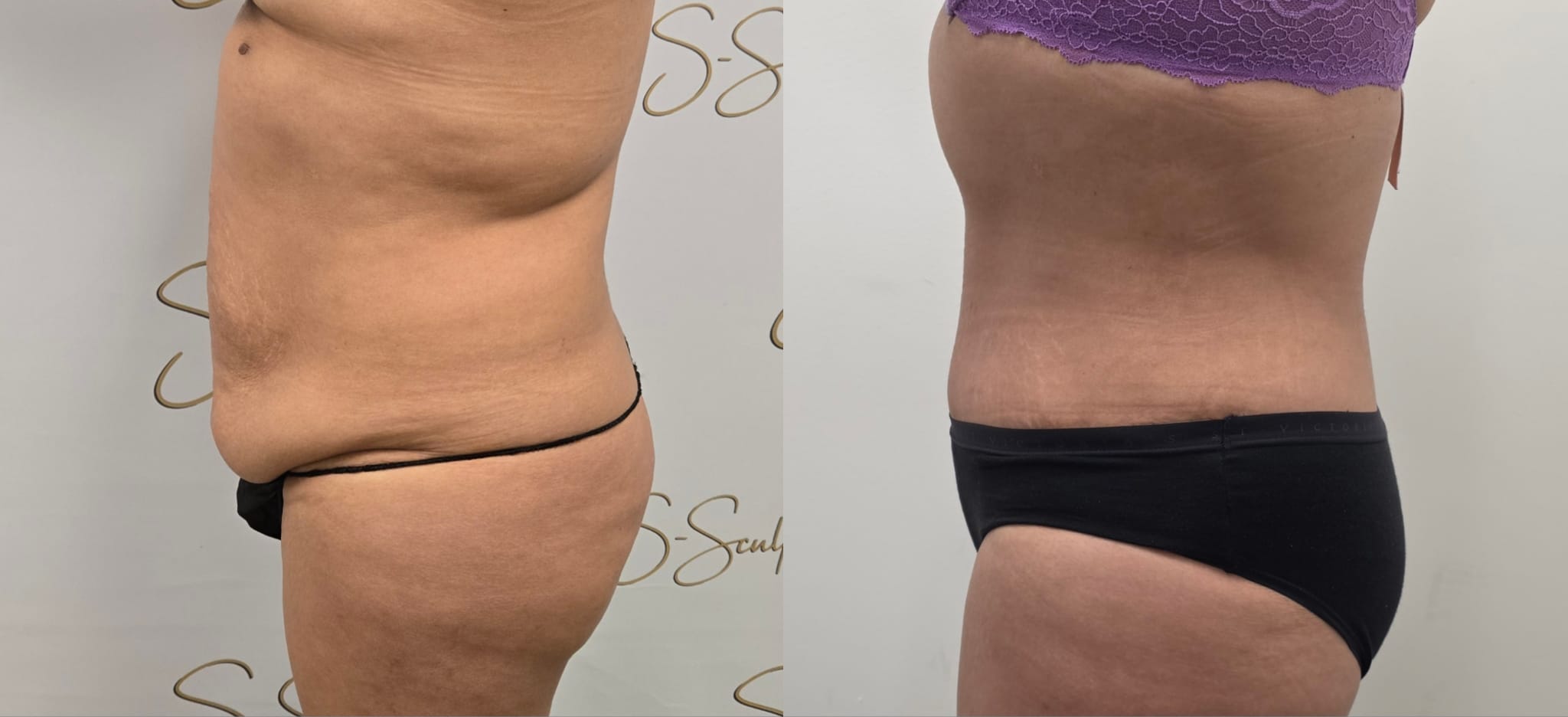 liposuction surgery before after results 2024