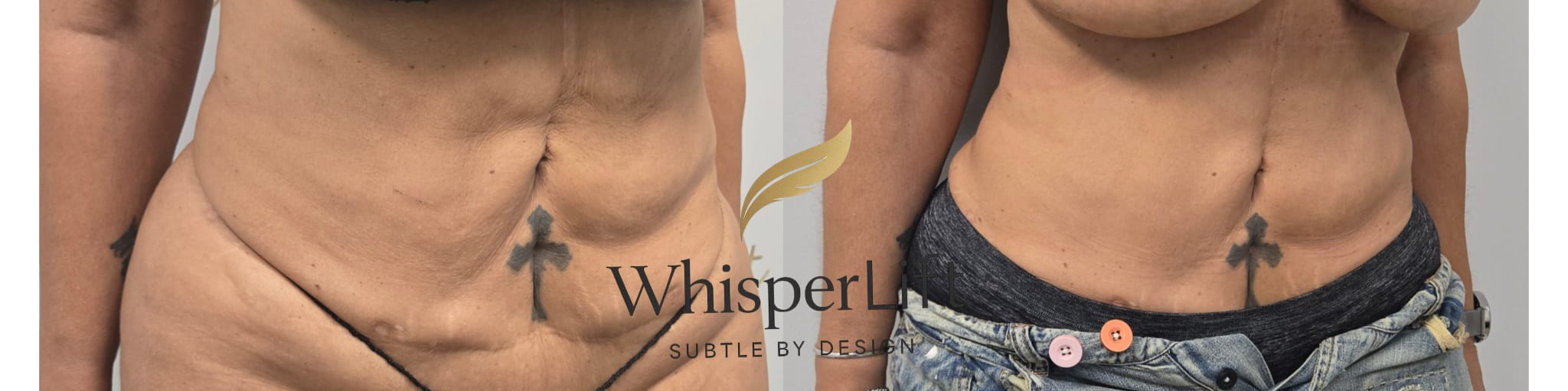 liposuction surgery before after results 2024