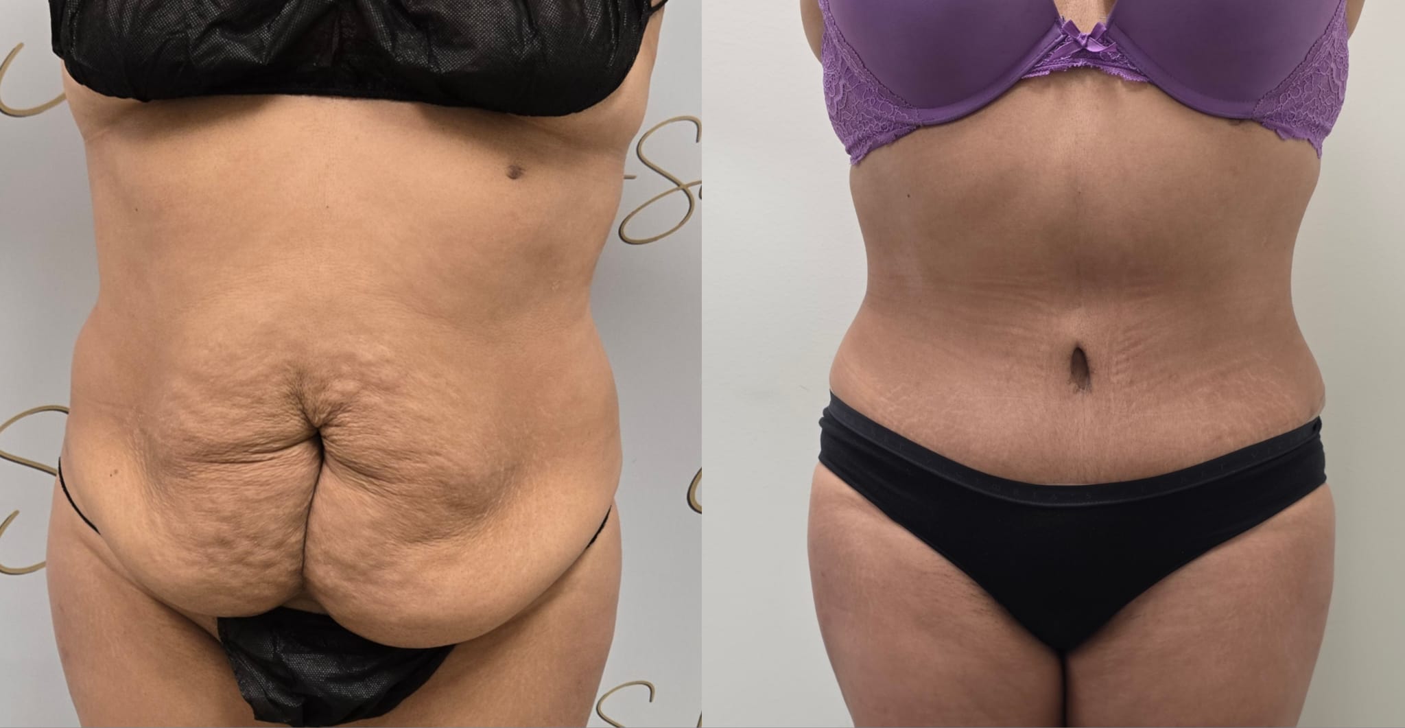 liposuction surgery before after results 2024