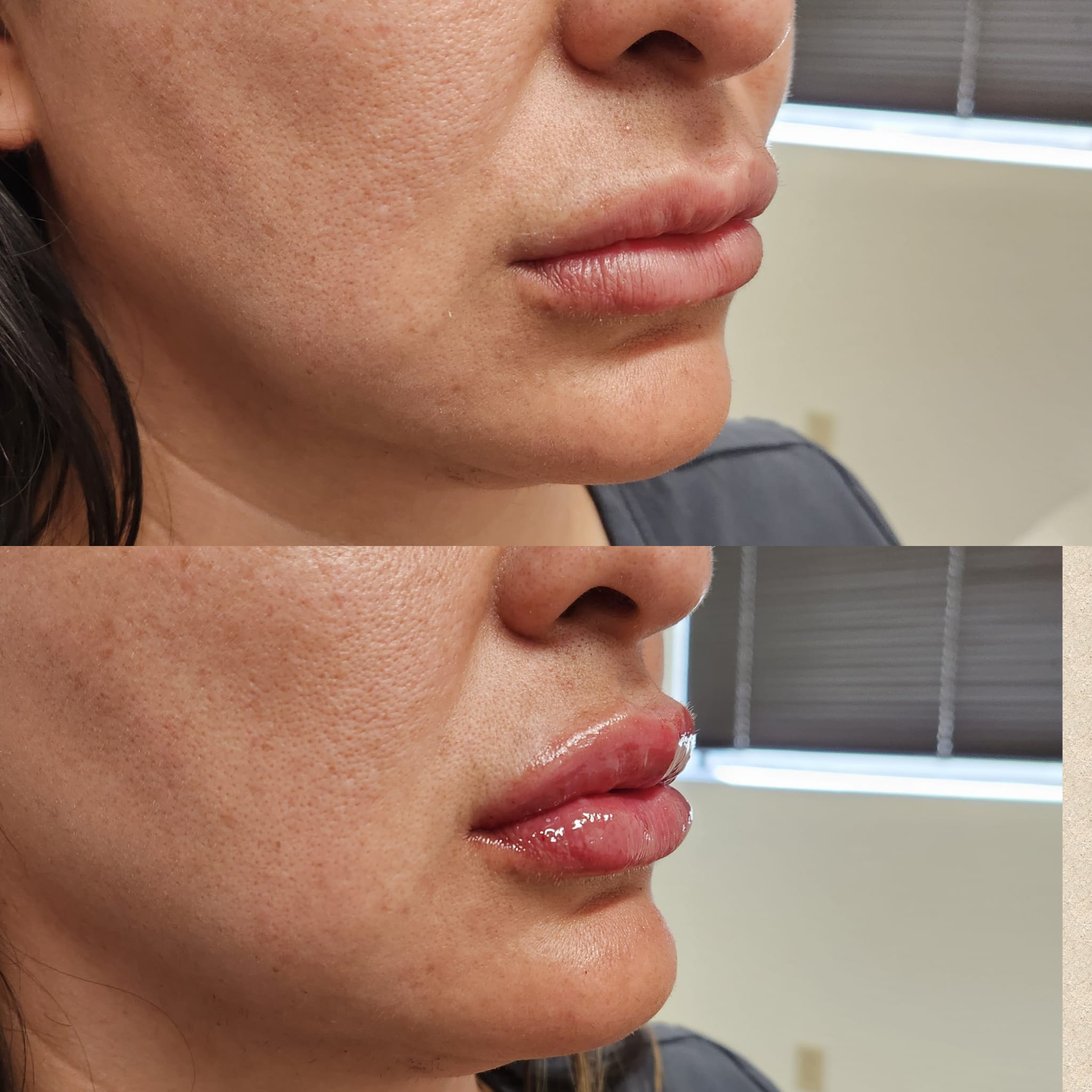 lip injection clinic