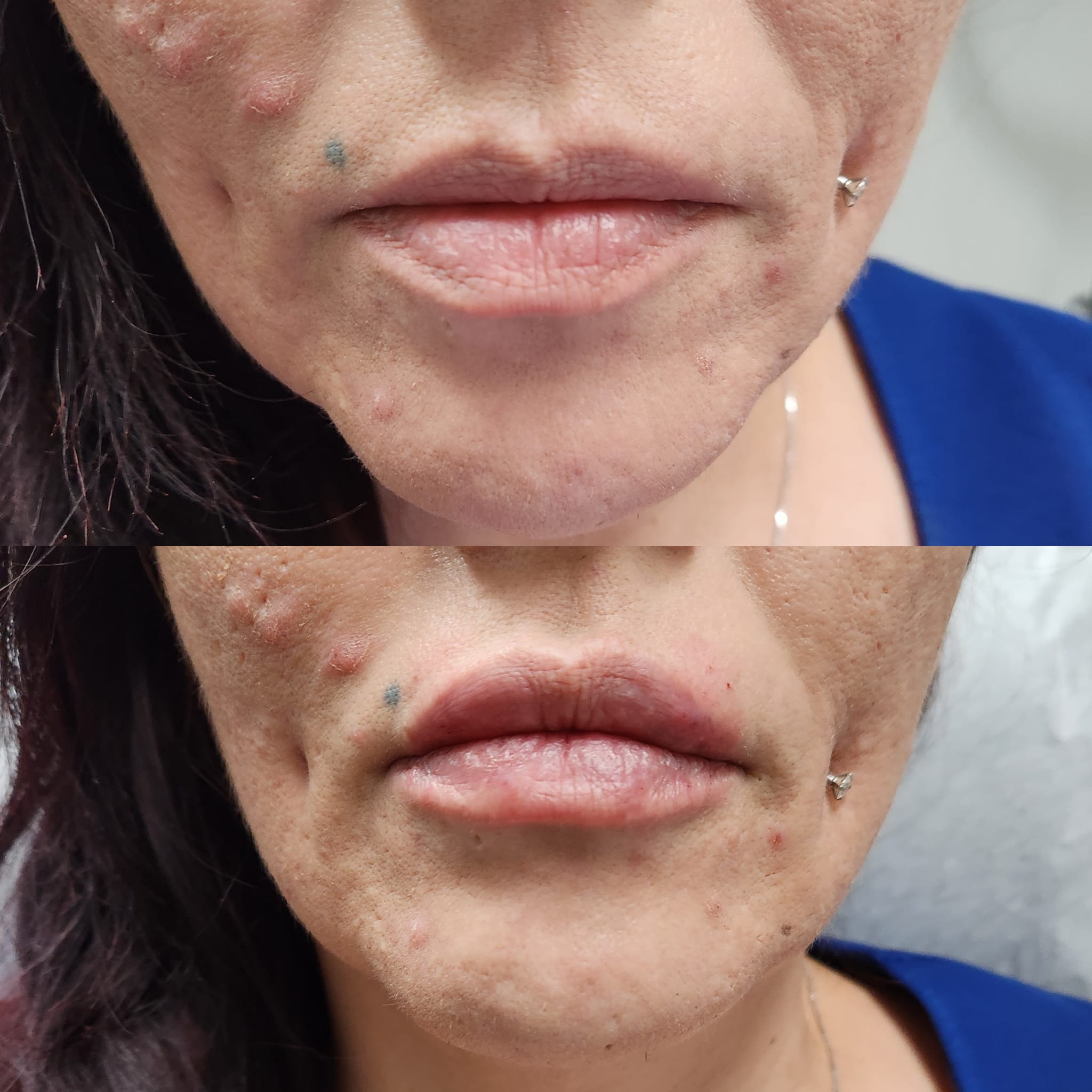 lip injection clinic
