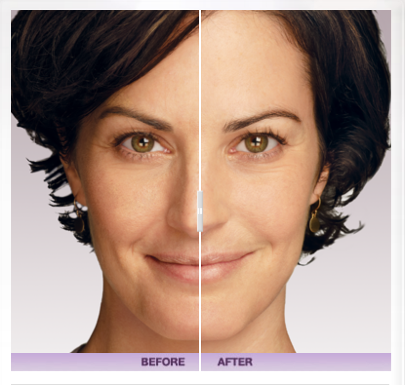 Juvéderm® VOLUMA® XC Before & After