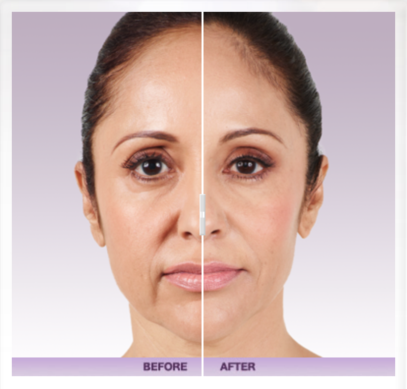 Juvéderm® VOLUMA® XC Before & After