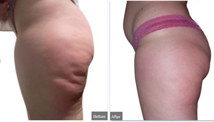 skin-tightening-treament